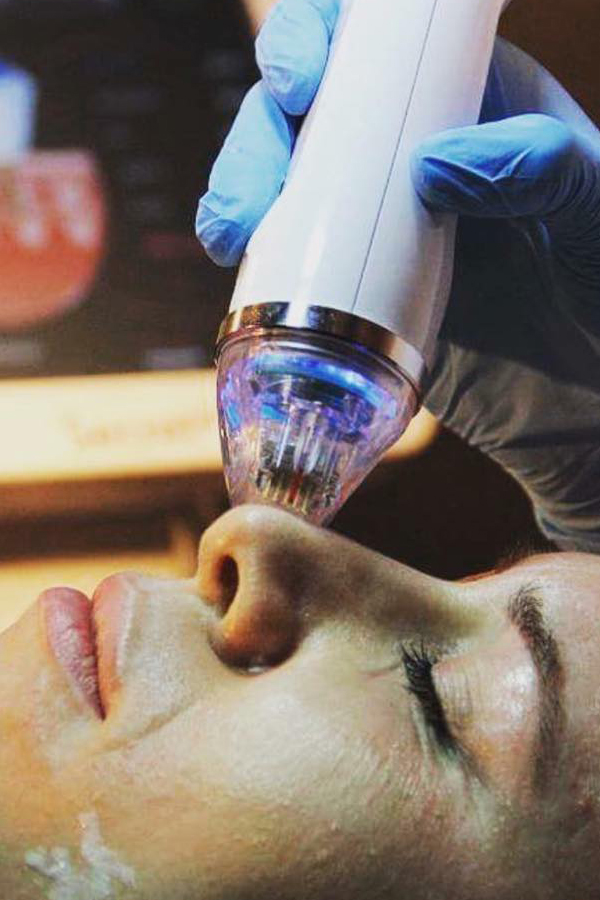 Tighten and Rejuvenate Skin with Fractional RF (Radiofrequency) Microneedling